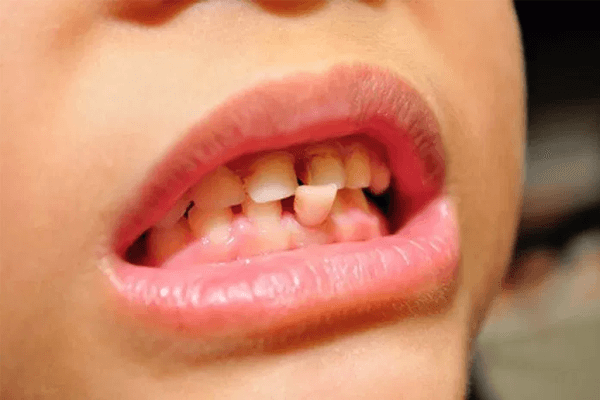 Featured image of post Sonhar Com Dente Podre Caindo Sonhar com dente podre geralmente est associado a perdas em sua vida