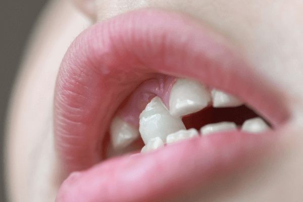 Significado de sonhar com dente: saiba como interpretar o que quer dizer