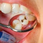 Sonhar com dente cariado – O que significa? Todos os resultados!