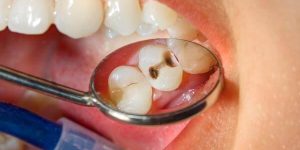 Sonhar com dente cariado