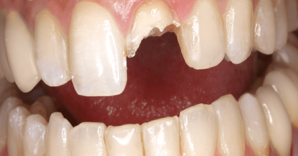 Featured image of post Sonhar Com Dentes Tortos Sonhar com dente torto de modo geral significa que suas escolhas na vida de vig lia est o desalinhadas com seu pop sito