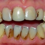 Sonhar com dente estragado – O que significa? Confira, aqui!