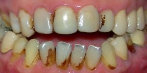 Sonhar com dente estragado