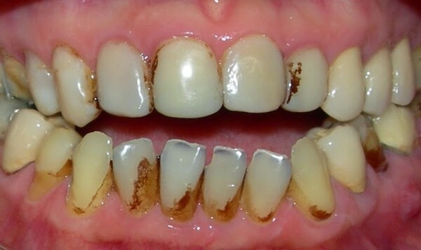 Featured image of post Imagens De Dente Estragado / Dente é uma estrutura localizada na boca que é dura, saliente e esbranquiçada composta por polpa, dentina e esmalte que é originada no maxilar e na mandíbula (ou arcada dentária no ser humano) de muitos vertebrados.