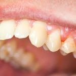 Sonhar com dente sangrando – O que significa? Respostas, aqui!