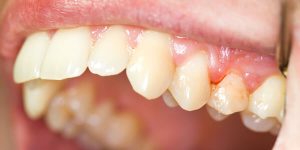 Sonhar com dente sangrando